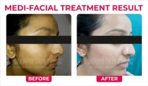 Hydrafacial Treatment Result